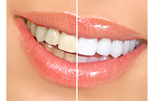 牙齿不够白？如何正确选择美白牙齿方式？