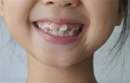 牙缝突然变大是因为什么？