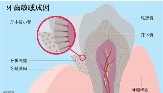 什么是牙齿敏感？ 